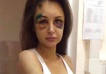 Rrihet barbarisht nga burri, 20-vjecarja nga Vlora hedh fotot ne Facebook