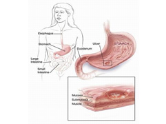 Cfare eshte ulcera ne stomak, si kurohet ajo