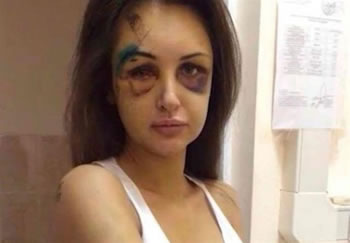 Rrihet barbarisht nga burri, 20-vjecarja nga Vlora hedh fotot ne Facebook